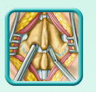 Thumb-lumbar-laminectomy-image