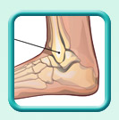 Thumb-arterial-ulcer-image